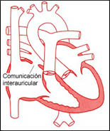 Comunicación interauricular