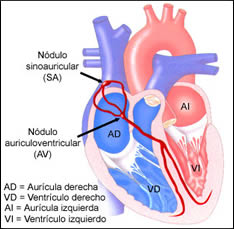 Arritmia