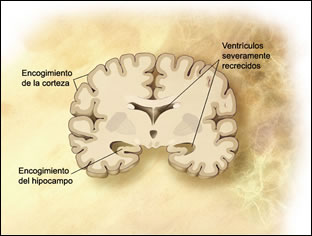 Trastornos de etiología orgánica: Demencias, Enfermedad de Parkinson,  Enfermedad de Niemann-Pick, Enfermedad de Huntington